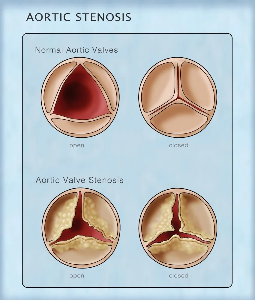 Medical illustration comparing normal aortic valves (open and closed) with aortic valve stenosis showing narrowed opening